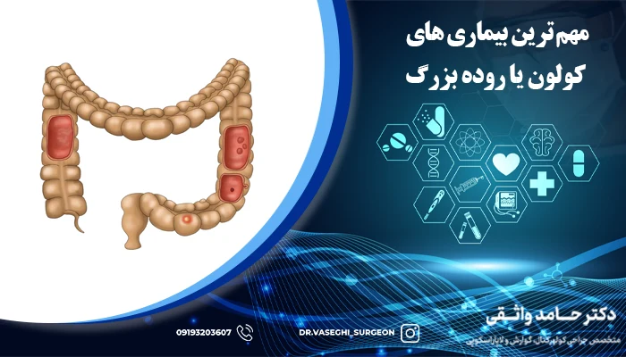 پیشگیری از بیماری های رکتوم