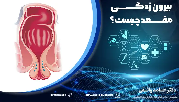 تصویر شماتیک بیرون زدگی مقعد