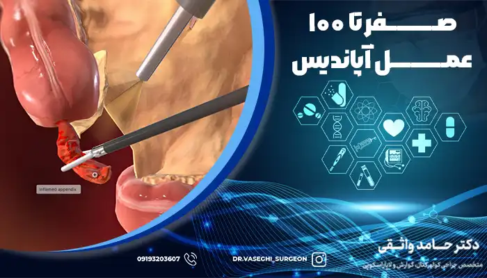 تصویر برداری ویدیویی از عمل آپاندیس