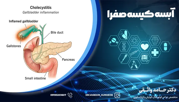 تصویری از وضعیت کیسه صفرا در زمان آبسه