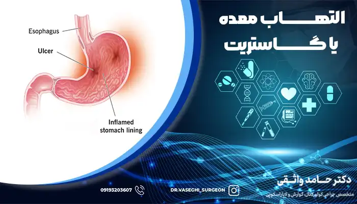 تصویر معده ملتهب به دلیل افزایش اسید معده