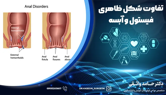 تفاوت شکل ظاهری فیستول و آبسه