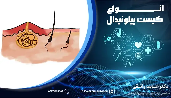 انواع کیست مویی دنبالچه و محل ایجاد آن
