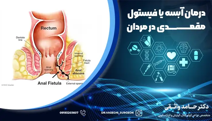 محل ایجاد فیستول و آبسه مقعدی در کانال مقعدی