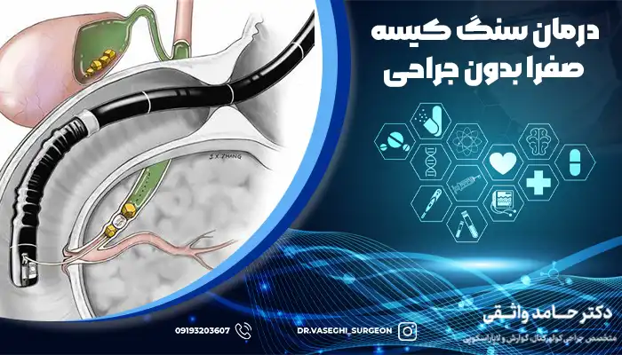 استفاده از روش لاپاراسکوپی و لیزر درمانی، از جمله روش های سنگ صفرا بدون جراحی است.