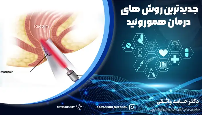 استفاده از لیزر و پلاسما به عنوان جدیدترین روش های درمان هموروئید شناخته می شوند.