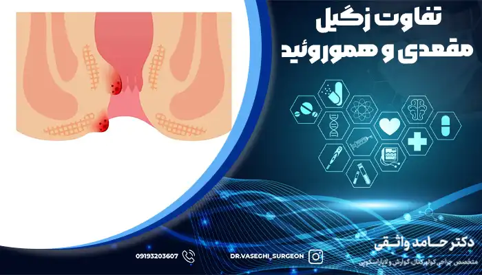 تفاوت محل قرارگیری هموروئید و زیگل مقعدی در مقعد