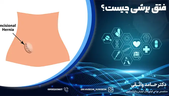 تصویر شماتیک محل ایجاد فتق برشی